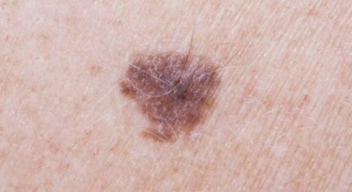 The oncologist told about the methods of detecting “cancerous” moles